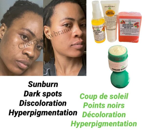 sunburn, discoloration, hyperpigmentation