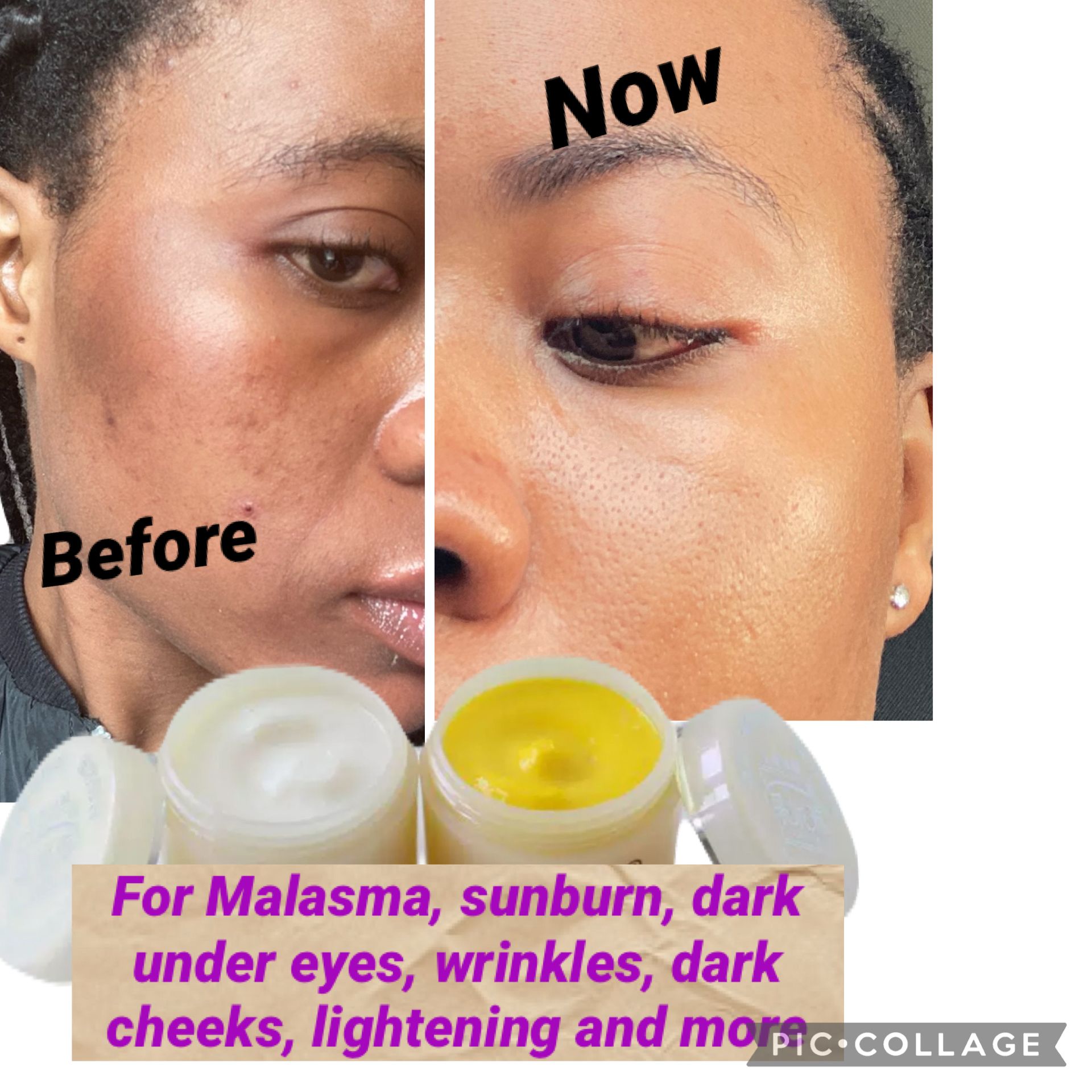 Day and Night Whitening and Lightning Cream for sunburn