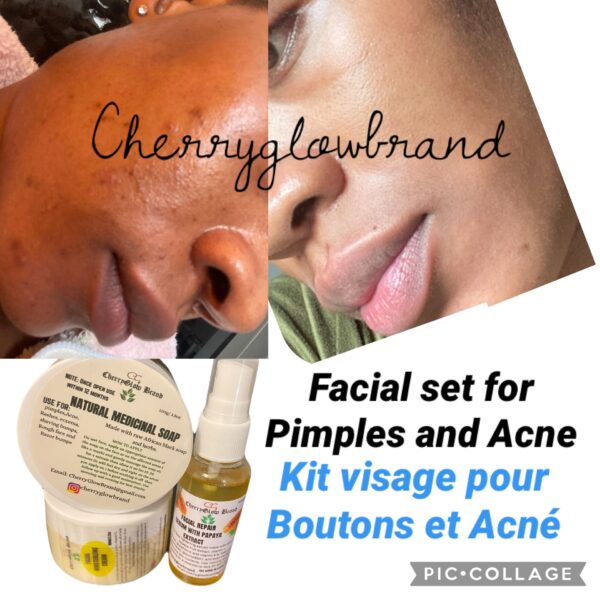 Clear pimples/ Acne and lighten dark discoloration