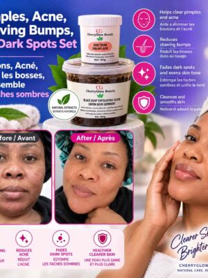 Pimples,Acne and Dark Spots Treatment large Pimples,Acne and Dark Spots Treatment
