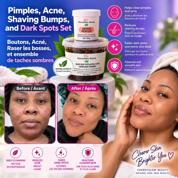 Pimples,Acne and Dark Spots Treatment