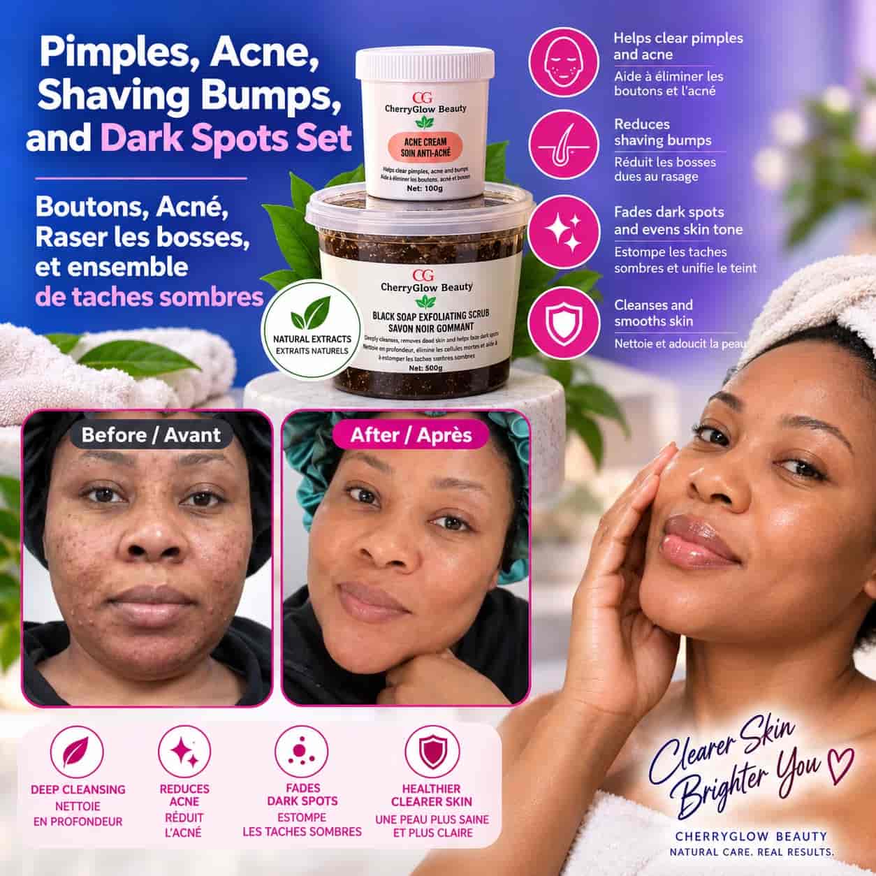 Pimples,Acne and Dark Spots Treatment